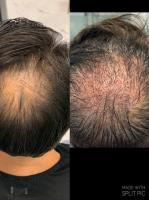 Pure Hair Restoration Center image 2